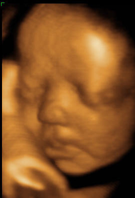 Drt boyutlu ultrason, ultrasonografi, 4d, 3d ultrason, ayrntl ultrason