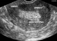 Endometrial kal�nla�ma, kal�nl�k art���, rahim i�i kal�nla�ma, endometrium, rahim i�i zar� kal�nl�k art���