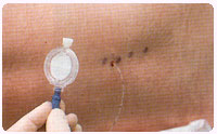 epidural-kateter.jpg