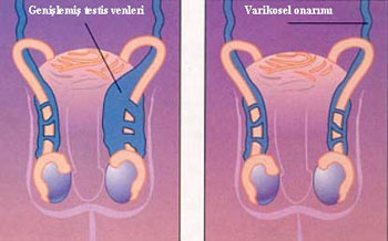 �nfertilite erkek fakt�r�, cerrahi tedaviler, varikosel