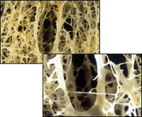 Osteoporoz, kemik erimesi, kemik kırılması, osteoporos