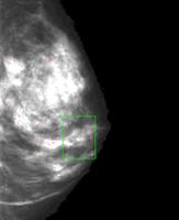 mammografi ile meme kanseri teşhisi, mamografi
