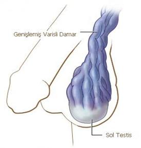 Varikosel, damar geni�lemesi