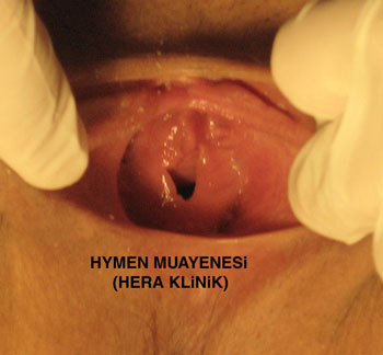 Kzlk zar muayenesi, bekaret kontrol, bakire, bekaret, himen muayenesi, himen kontrol, bakirelik testi