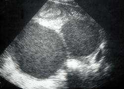 Ultrasonda çikulata kisti, endometrioma, çikolatakisti