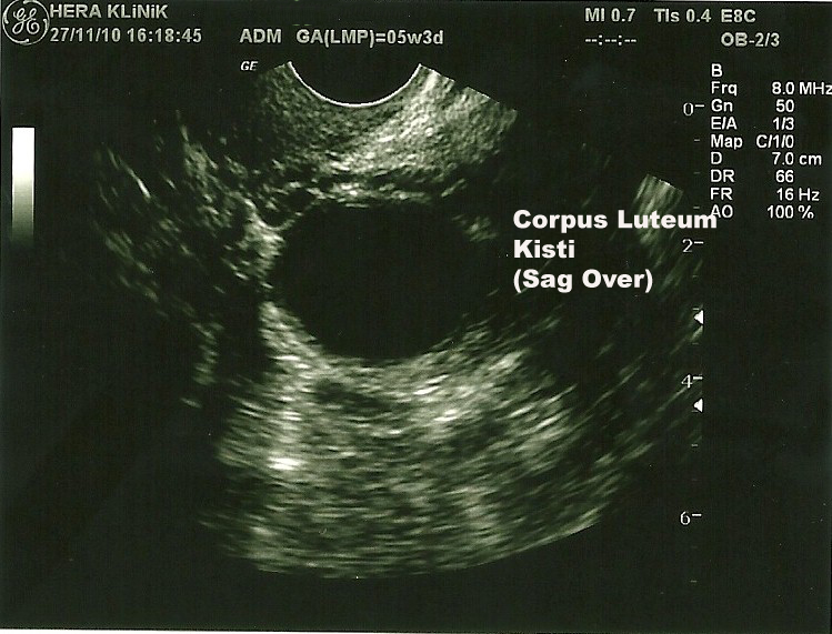 Corpus luteum kisti, 5 haftalık gebelik