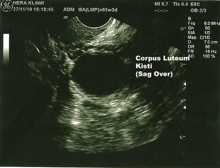 Corpus luteum kisti, 5 haftalk gebelik