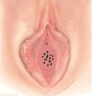 KRBRFORM HYMEN: Kzlk zar bir 