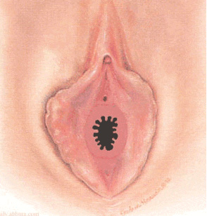 DENTKULER HYMEN
