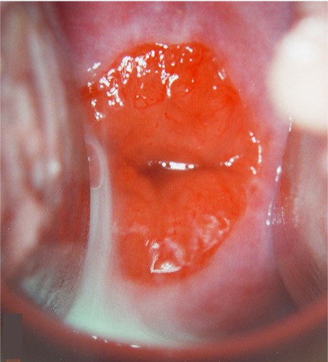 Serviks, rahim az, rahim ucu, cervix