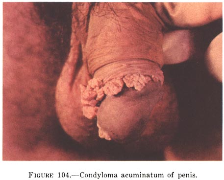 Kondiloma, Condyloma, Condyloma accuminata, Genital siil, HPV enfeksiyonu, kondilom, rahim az kanseri, kanser as