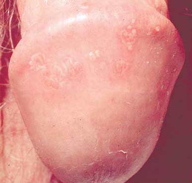 Penis banda uuk, tip 2 genital herpes