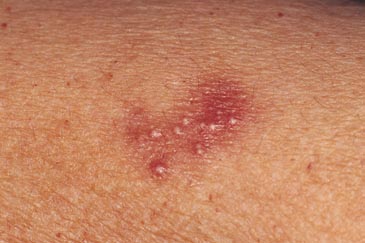 Genital herpes, HSV Tip 2, Genital Uuk, herpes enfeksiyonu