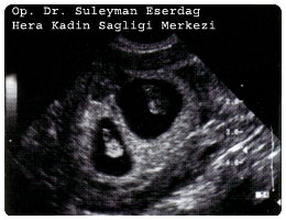 İkiz gebelik ultrasonu