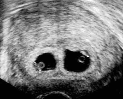 İkiz gebeliğin ultrasonografik görünümü, bir çift yumurta ikizi.