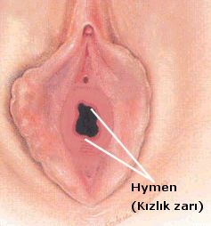 Kzlk zar, hymen, hymeoplasti, kzlk, bekaret, himen, kzlk zar tamiri, himenoplasti