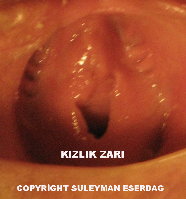 Kzlk zar nedir? Nerededir?
