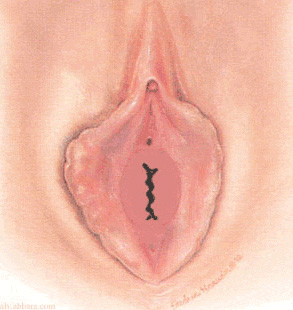 LABAL HYMEN: Dudaa benzer grnm.