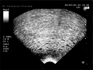 Mol gebeliği, ultrason görünümü, üzüm gebeliği
