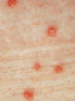 molluscum-contagiosum.jpg