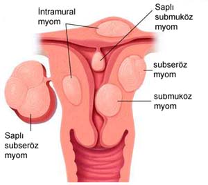 Rahimde ur, myom, miyon, muyon, myom, tmr, tumor