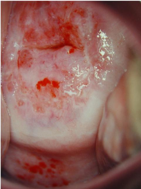 Serviks, rahim az, rahim ucu, cervix