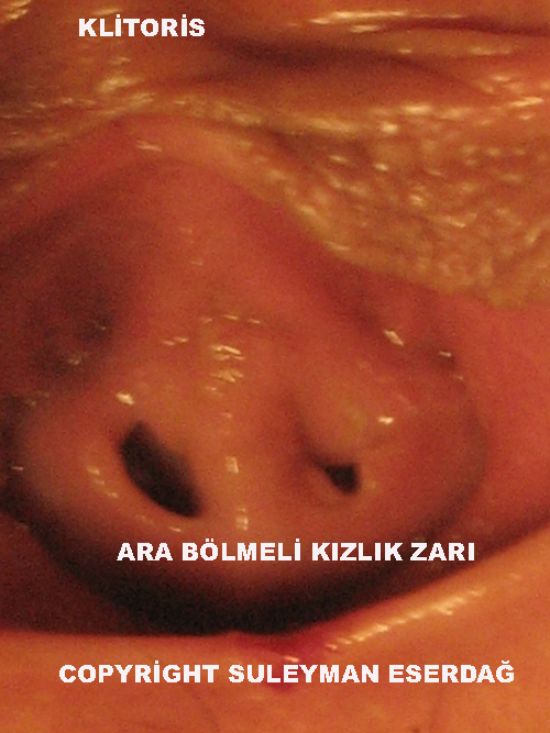 Ara blmeli kzlk zar- Kzlk Zar Muayenesi