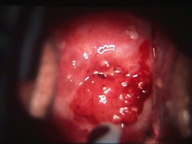 serviks kanseri, servikal kanser, cervix ca, rahim az kanseri
