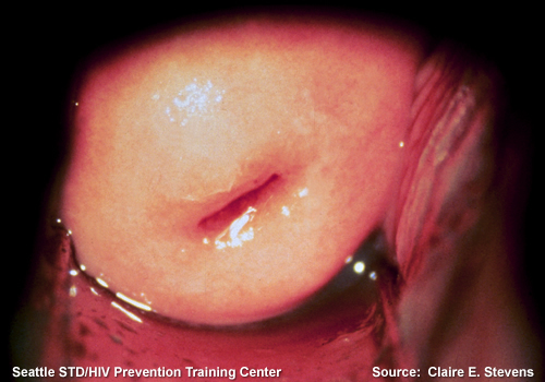 Serviks, rahim az, rahim ucu, cervix