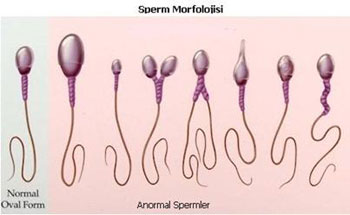 Sperm morfolojisi, yap bozukluklar