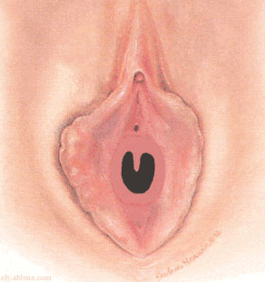 SUBSEPTAT HYMEN: Ara blmesi yarmdr..