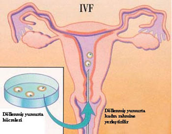 ivf uygulamas, tubal faktr