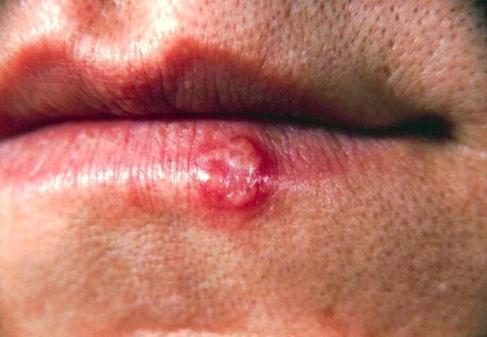 Azda uuk, dudak uuu, herpes tip 1