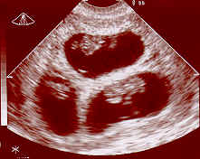 Üçüz gebelik, ultrason görünümü