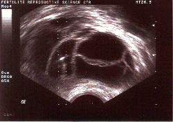 Vajinal ultrasonda uyarılmış over görünümü